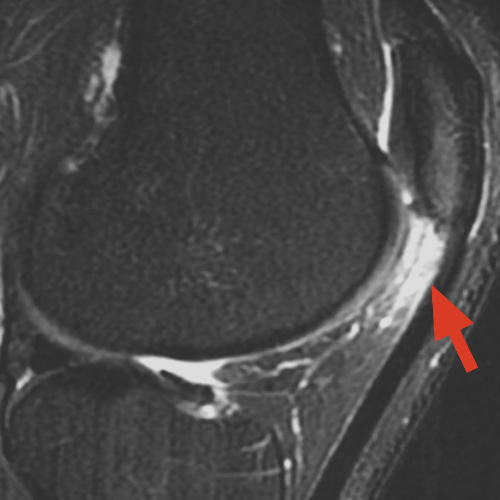 MRI of knee fat pad impingement (Hoffa's Syndrome) with arrow pointing to the inflammation below the patella