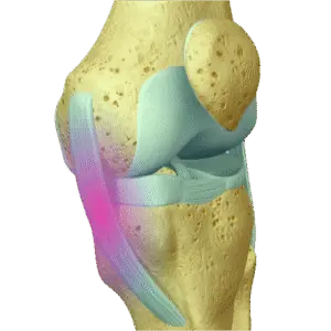 Image of an MCL sprain showing the medial collateral ligament on the inner knee, a common cause of pain and instability after injury
